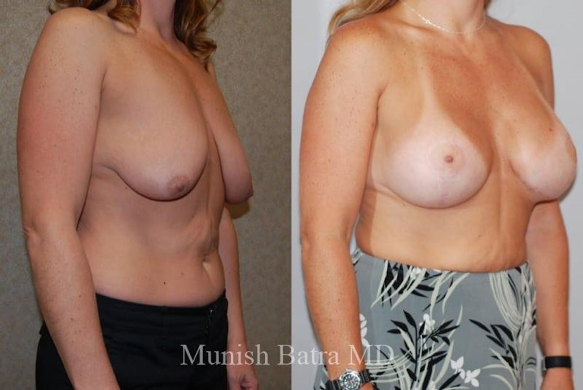 Breast Augmentation with Lift Mastopexy Before & After Gallery - Patient 478096 - Image 2