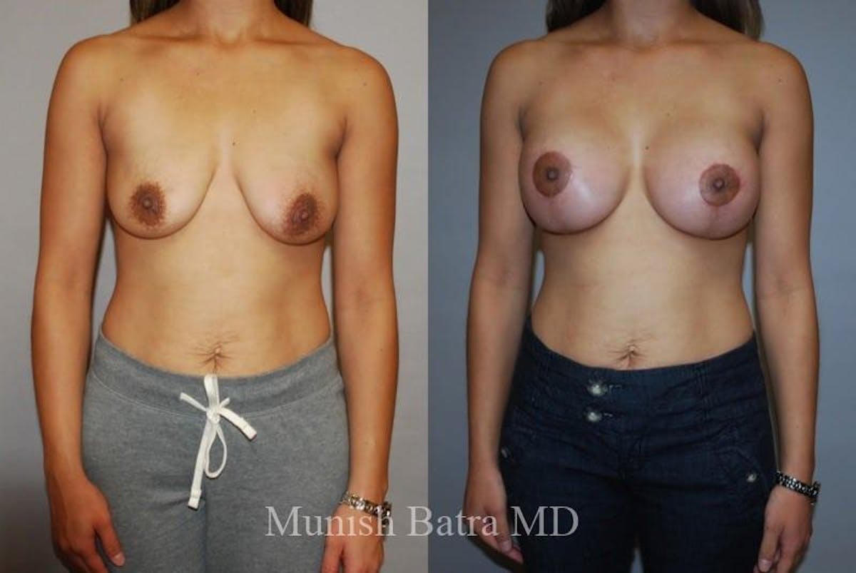 Breast Augmentation with Lift Mastopexy Before & After Gallery - Patient 408084 - Image 1
