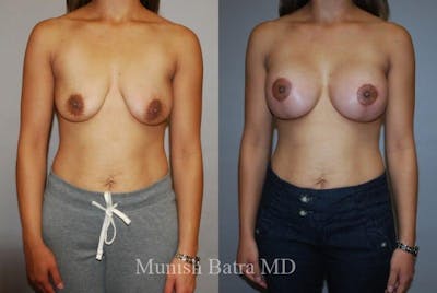 Breast Augmentation with Lift Mastopexy Before & After Gallery - Patient 408084 - Image 1