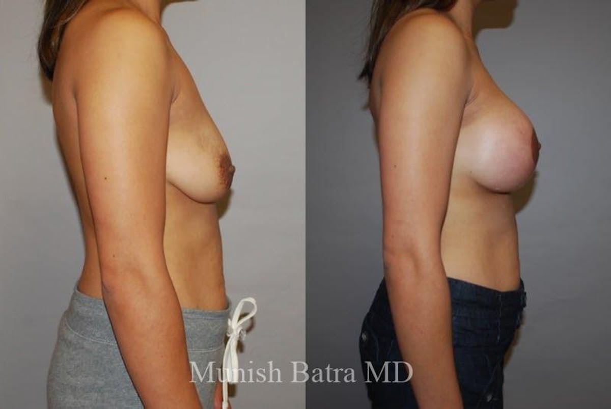 Breast Augmentation with Lift Mastopexy Before & After Gallery - Patient 408084 - Image 2
