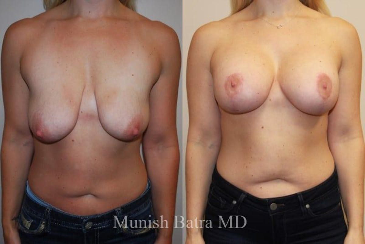 Breast Augmentation with Lift Mastopexy Before & After Gallery - Patient 462210 - Image 1