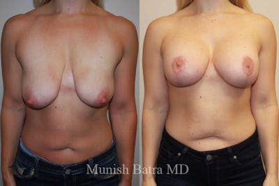 Breast Augmentation with Lift Mastopexy Before & After Gallery - Patient 462210 - Image 1