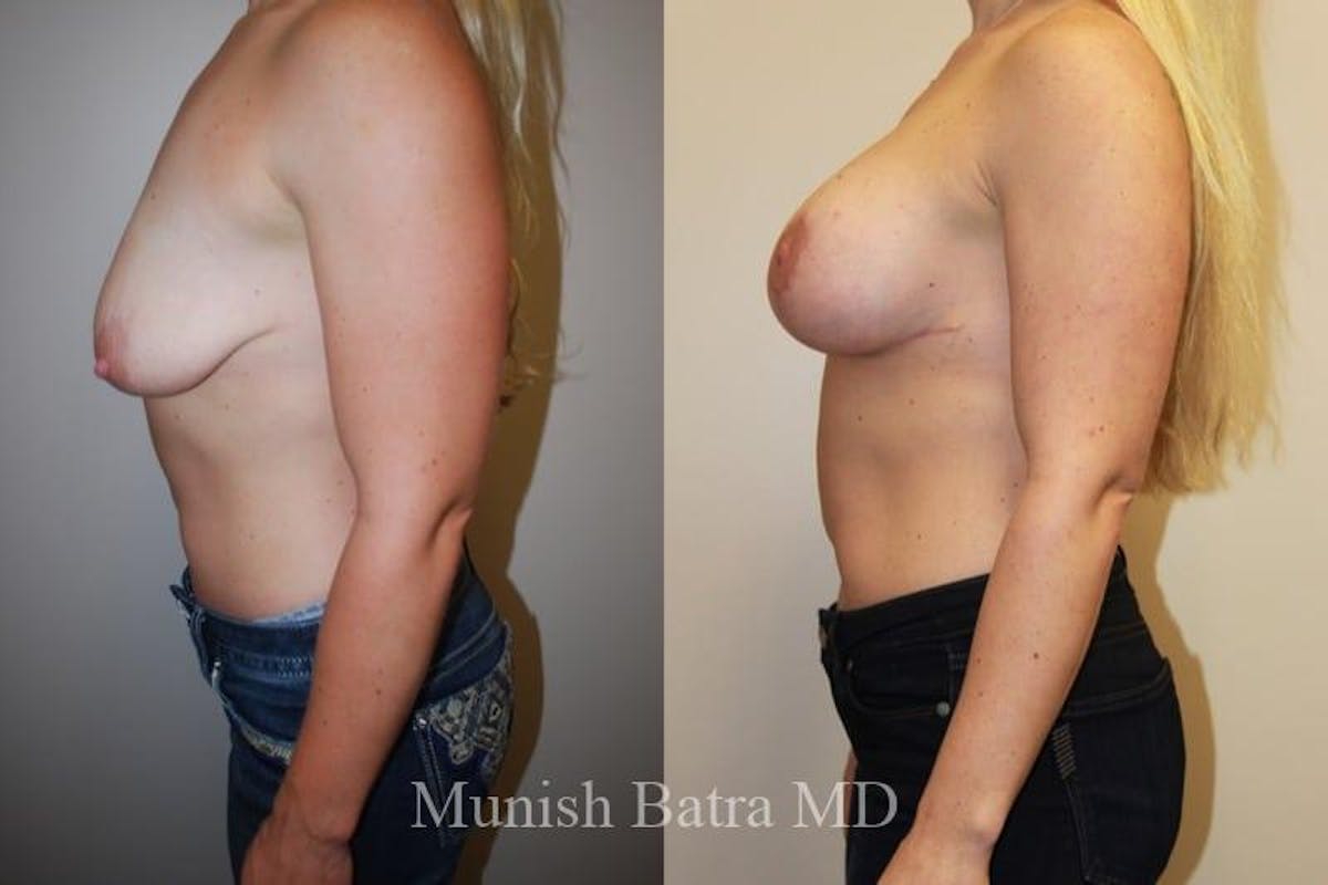 Breast Augmentation with Lift Mastopexy Before & After Gallery - Patient 462210 - Image 2
