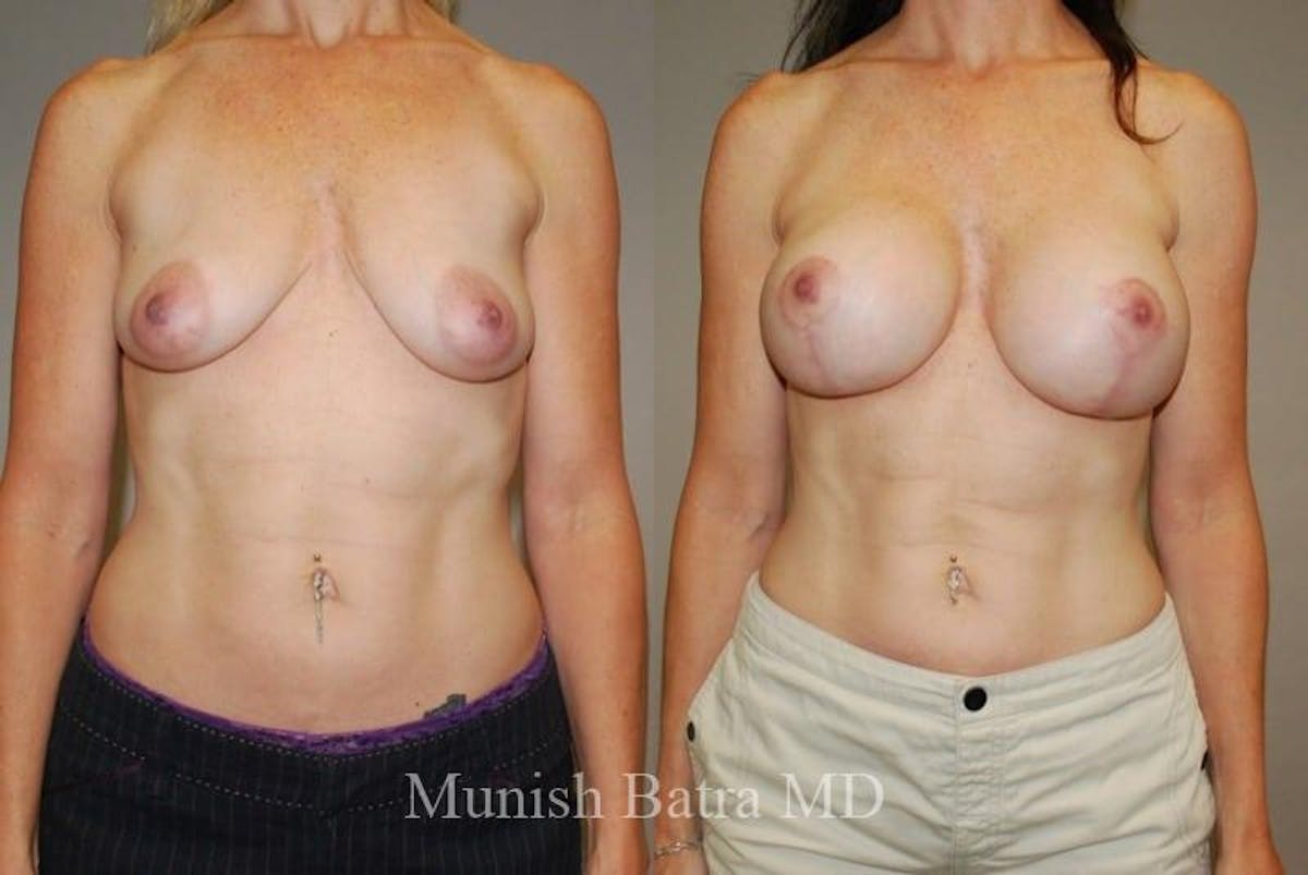 Breast Augmentation with Lift Mastopexy Before & After Gallery - Patient 342997 - Image 1