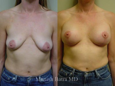Breast Augmentation with Lift Mastopexy Before & After Gallery - Patient 391584 - Image 1