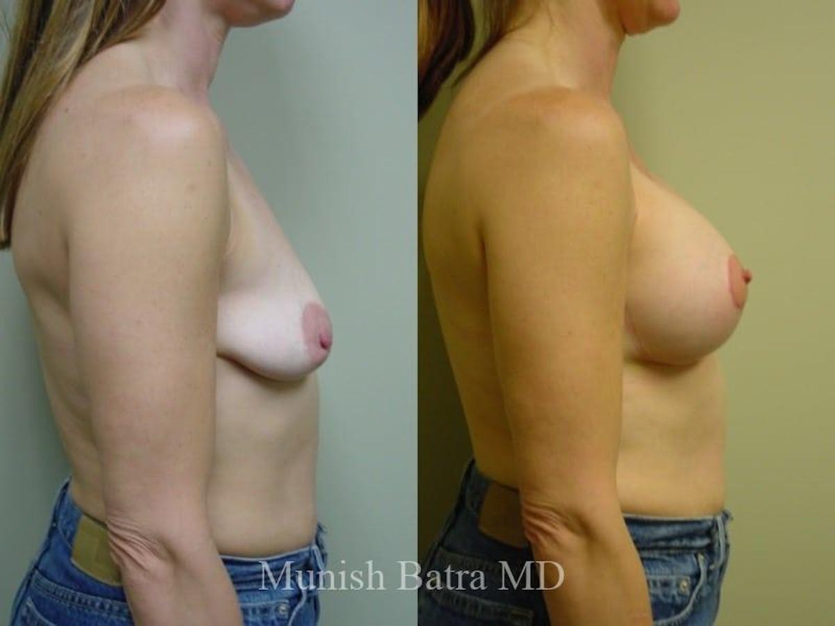 Breast Augmentation with Lift Mastopexy Before & After Gallery - Patient 391584 - Image 2