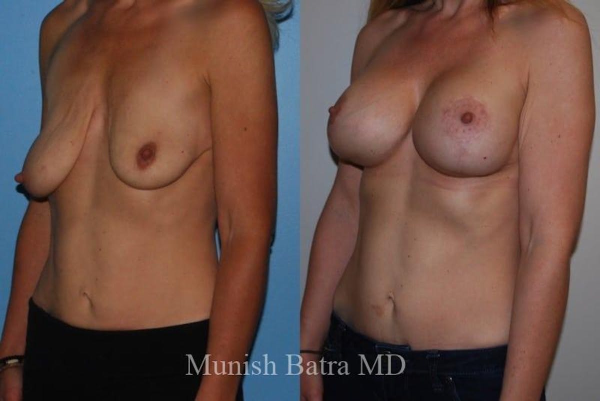 Breast Augmentation with Lift Mastopexy Before & After Gallery - Patient 353622 - Image 1