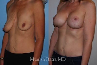 Breast Augmentation with Lift Mastopexy Before & After Gallery - Patient 353622 - Image 1