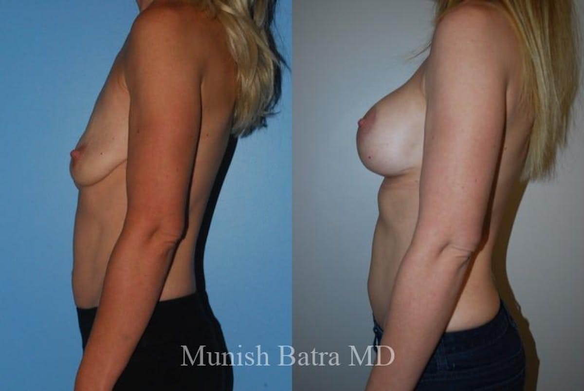 Breast Augmentation with Lift Mastopexy Before & After Gallery - Patient 353622 - Image 2