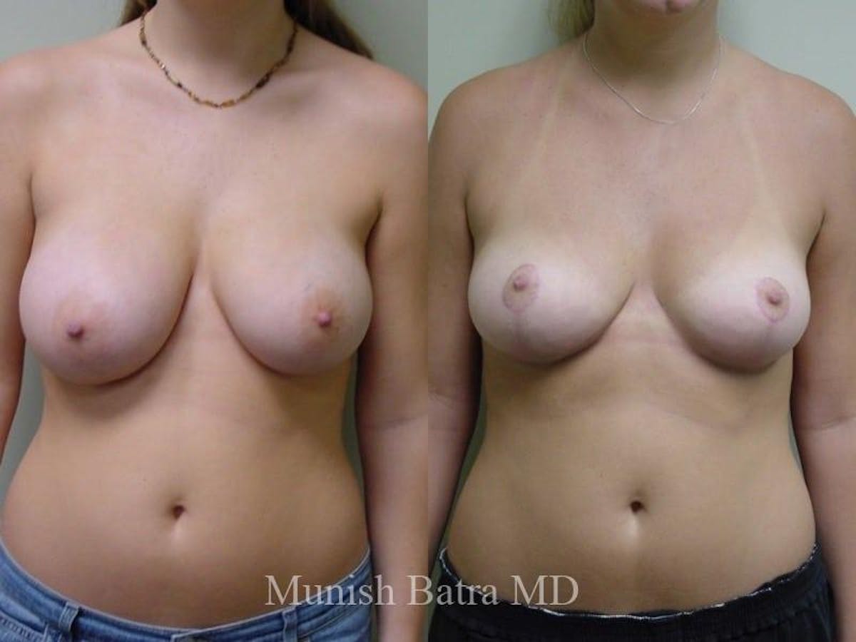 Breast Augmentation with Lift Mastopexy Before & After Gallery - Patient 150341 - Image 1