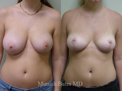 Breast Augmentation with Lift Mastopexy Before & After Gallery - Patient 150341 - Image 1