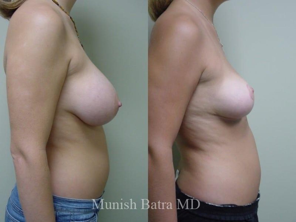 Breast Augmentation with Lift Mastopexy Before & After Gallery - Patient 150341 - Image 2