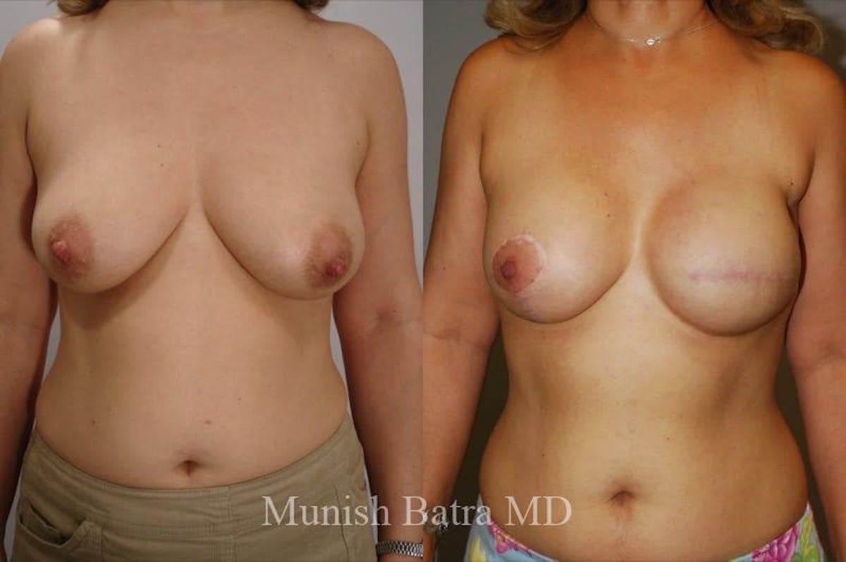 Breast Cancer Reconstruction Before & After Gallery - Patient 359447 - Image 1