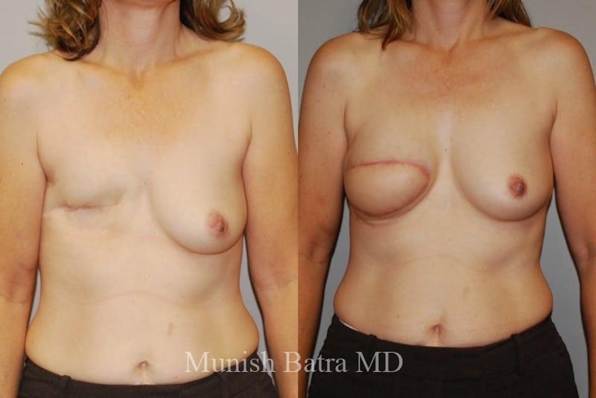 Breast Cancer Reconstruction Before & After Gallery - Patient 403605 - Image 1