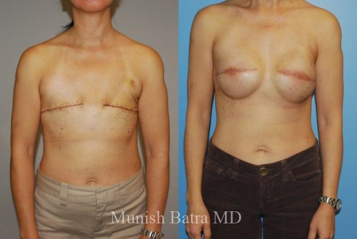 Breast Cancer Reconstruction Before & After Gallery - Patient 313499 - Image 1