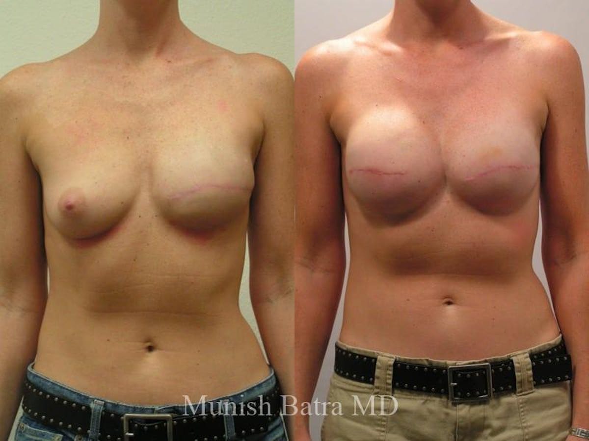 Breast Cancer Reconstruction Before & After Gallery - Patient 170089 - Image 1