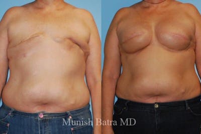 Breast Cancer Reconstruction Before & After Gallery - Patient 167637 - Image 1