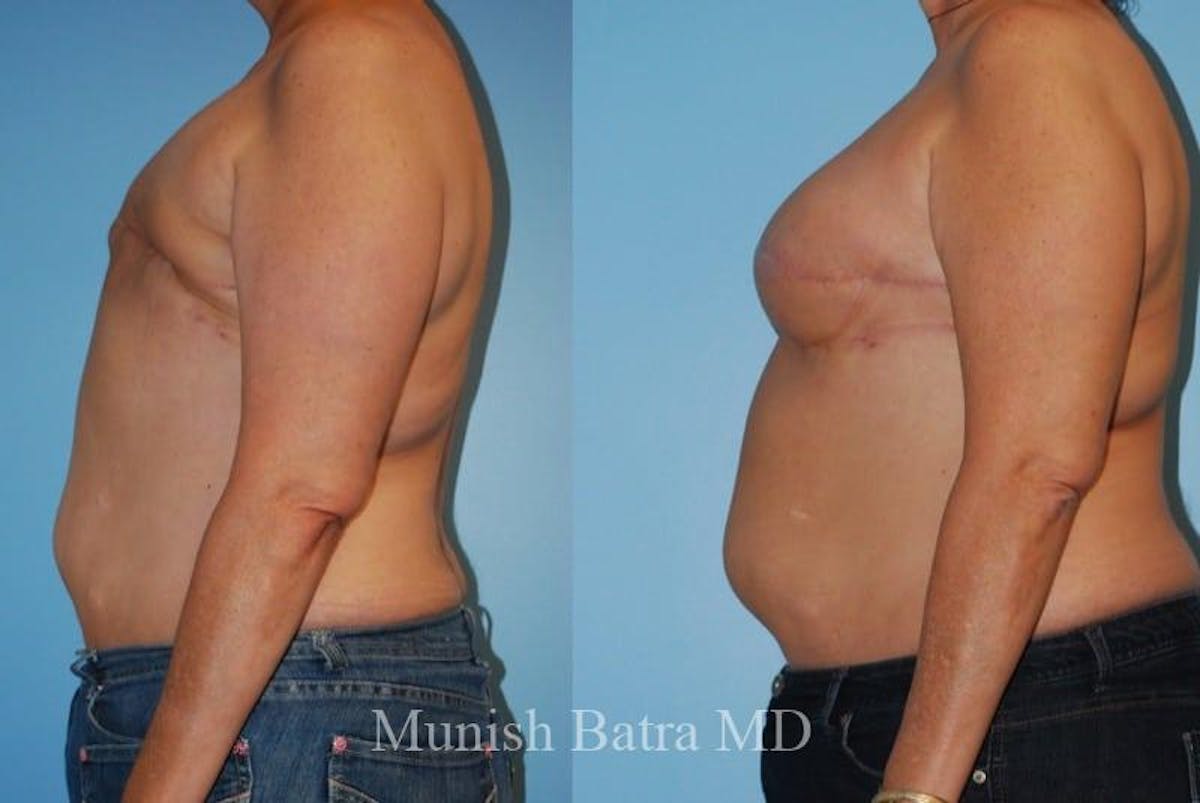 Breast Cancer Reconstruction Before & After Gallery - Patient 167637 - Image 2