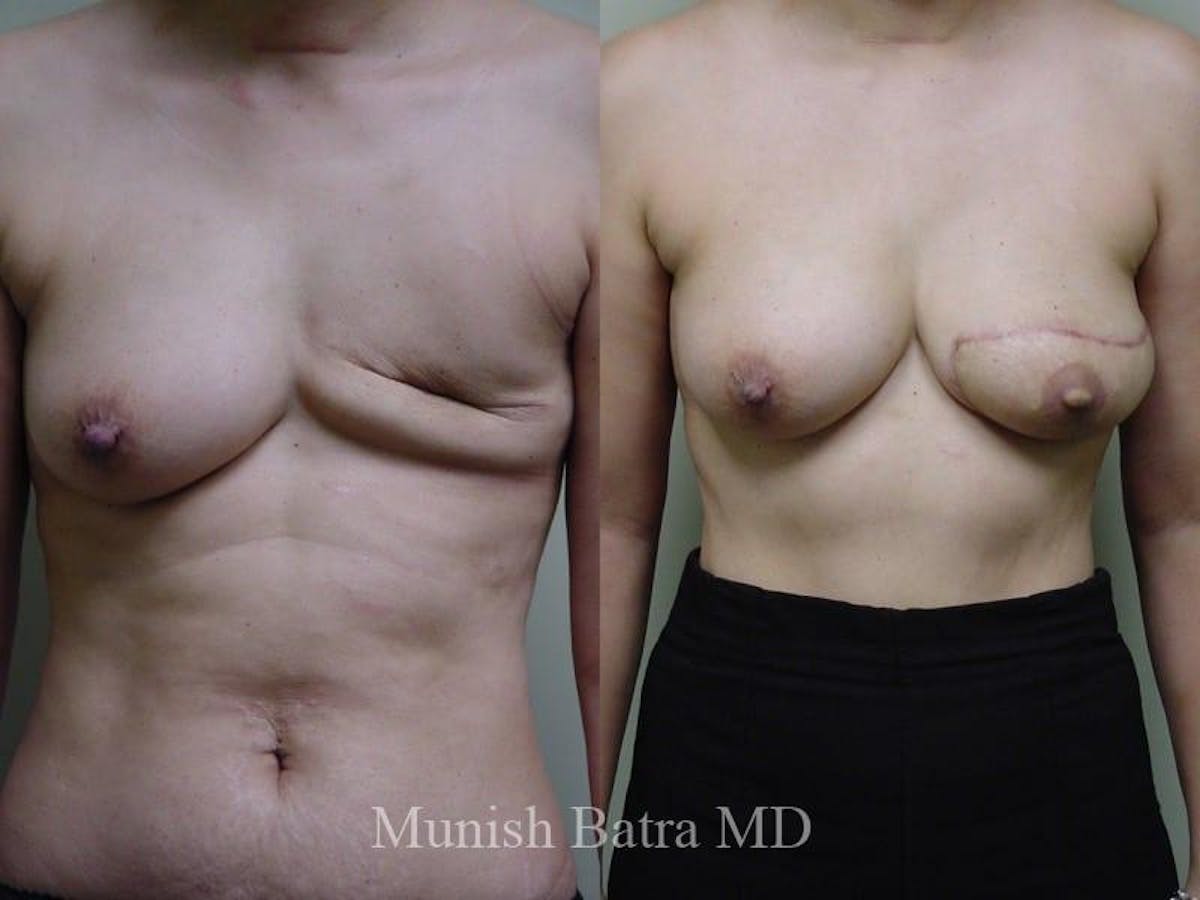 Breast Cancer Reconstruction Before & After Gallery - Patient 324406 - Image 1