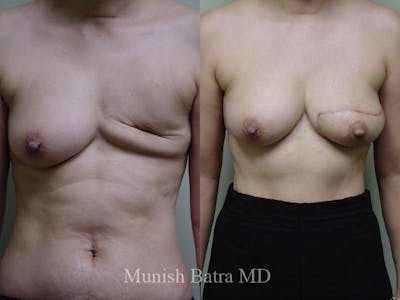 Breast Cancer Reconstruction Before & After Gallery - Patient 324406 - Image 1