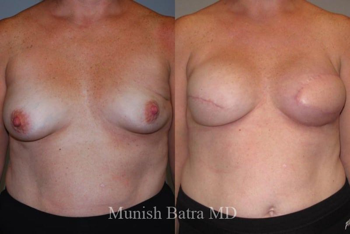 Breast Cancer Reconstruction Before & After Gallery - Patient 296819 - Image 1
