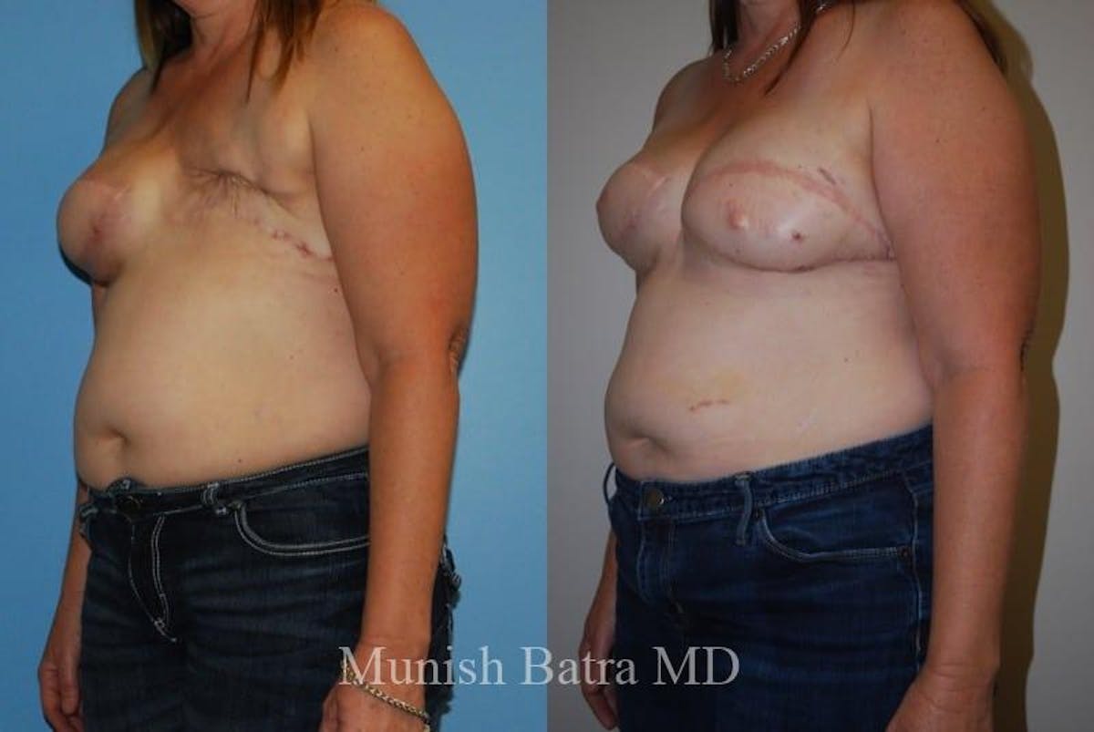 Breast Cancer Reconstruction Before & After Gallery - Patient 424670 - Image 1