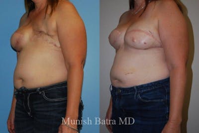 Breast Cancer Reconstruction Before & After Gallery - Patient 424670 - Image 1