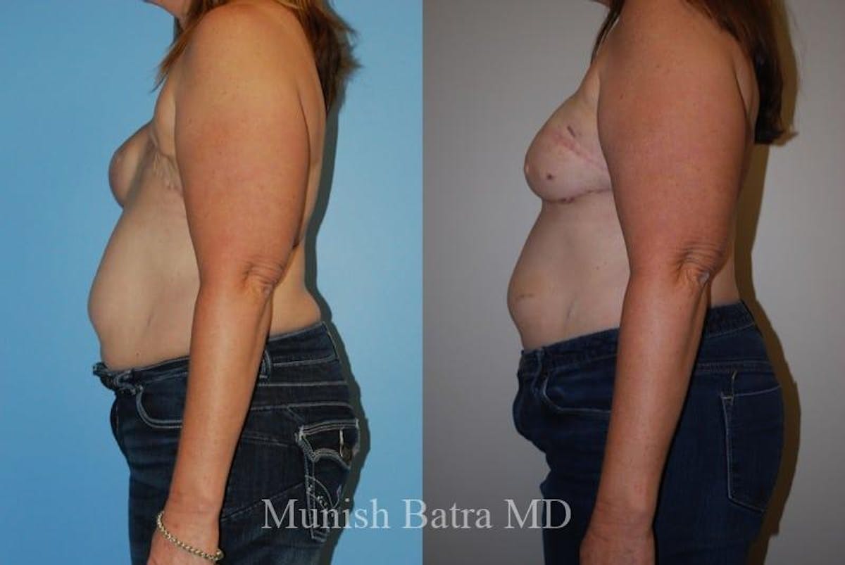 Breast Cancer Reconstruction Before & After Gallery - Patient 424670 - Image 2