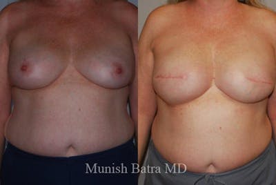 Breast Cancer Reconstruction Before & After Gallery - Patient 182093 - Image 1