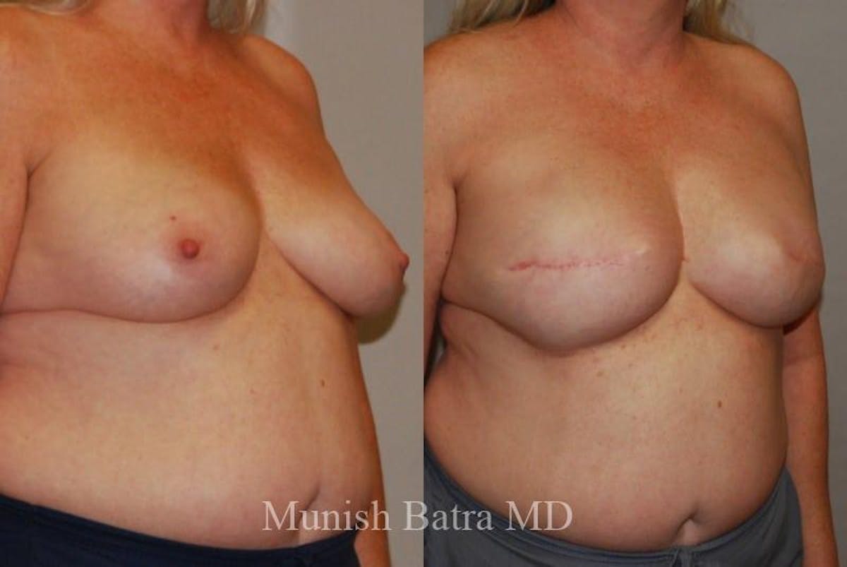 Breast Cancer Reconstruction Before & After Gallery - Patient 182093 - Image 2