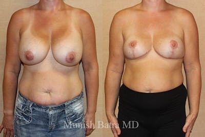 Breast Explant Before & After Gallery - Patient 327435 - Image 1
