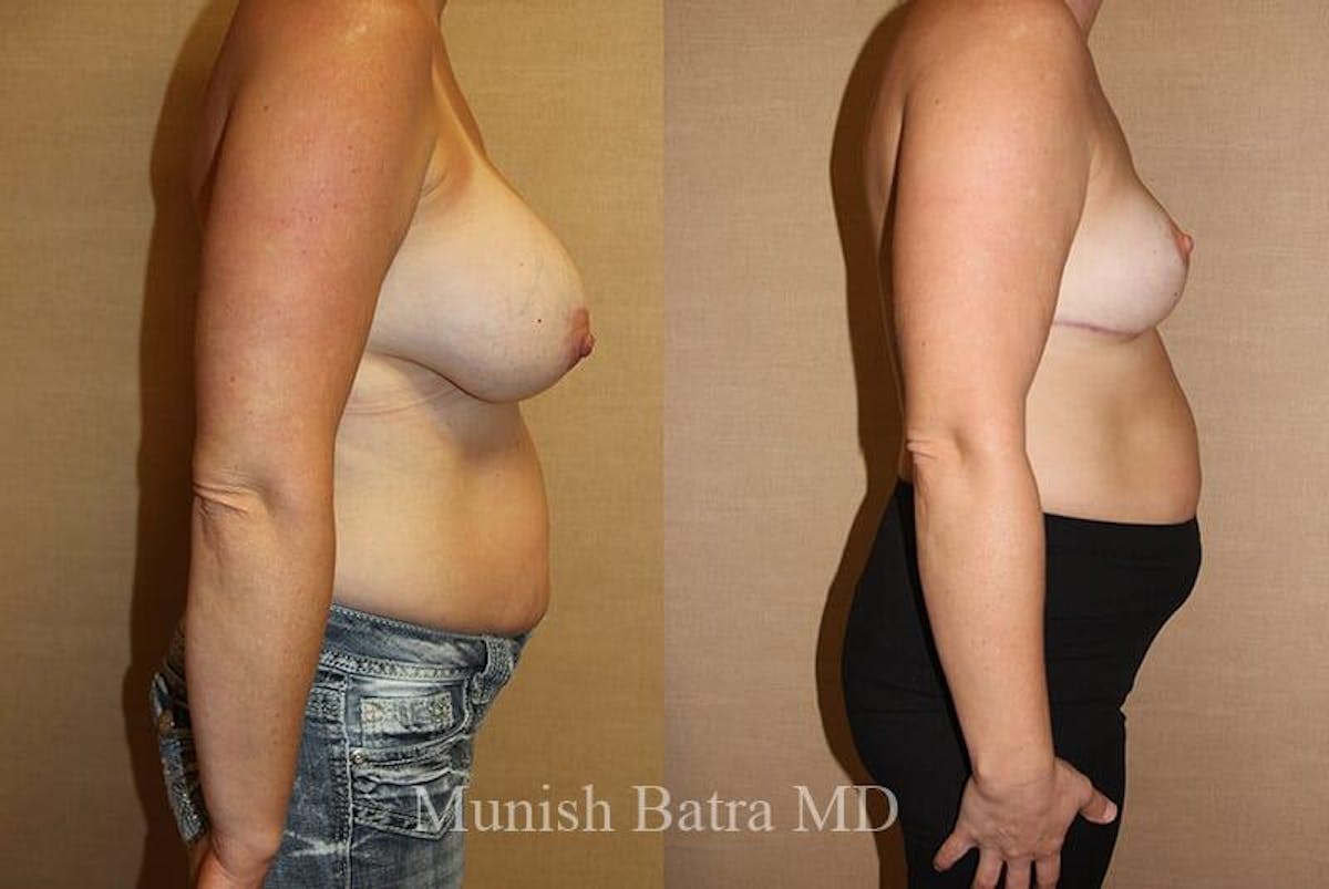 Breast Explant Before & After Gallery - Patient 327435 - Image 2