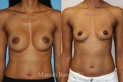 Breast Explant Before & After Gallery - Patient 269158 - Image 1