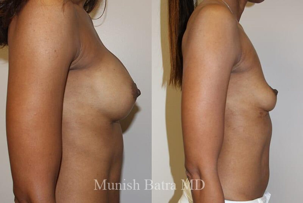 Breast Explant Before & After Gallery - Patient 269158 - Image 2