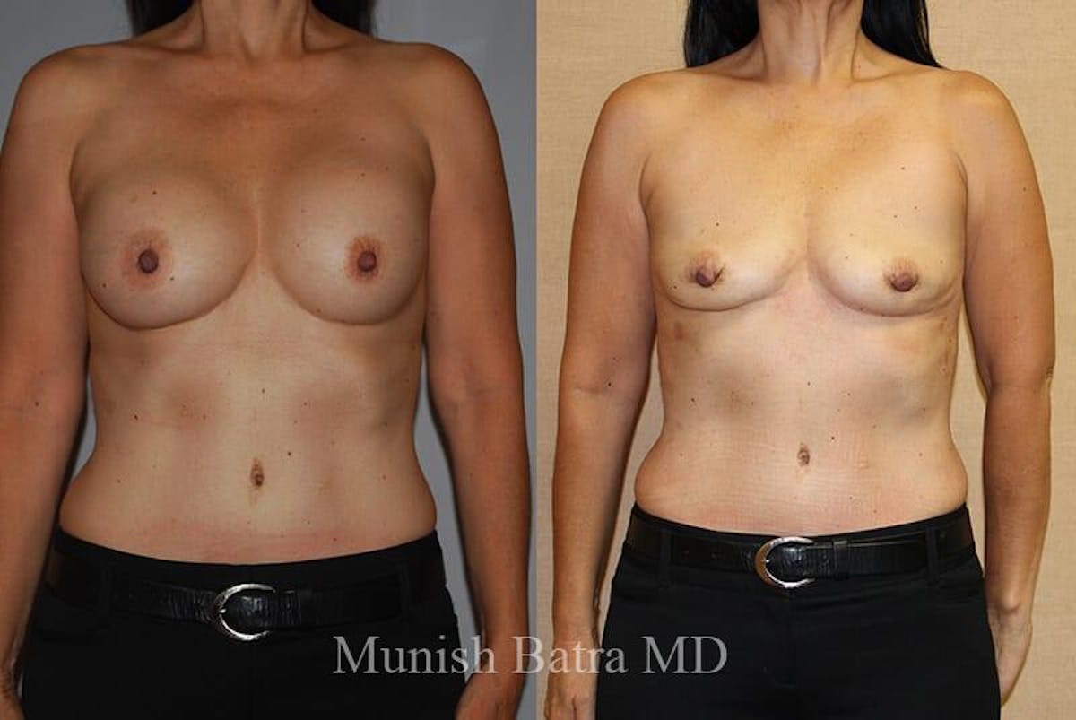 Breast Explant Before & After Gallery - Patient 370424 - Image 1