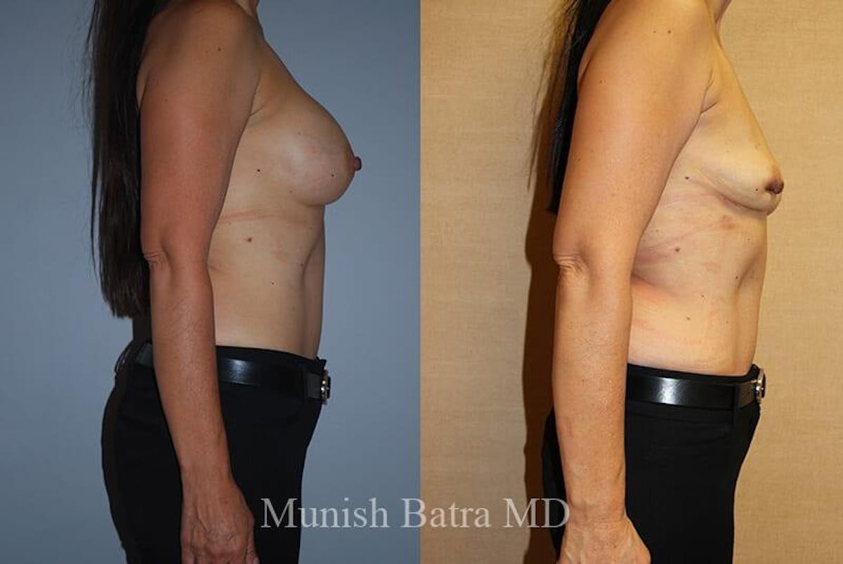 Breast Explant Before & After Gallery - Patient 370424 - Image 2