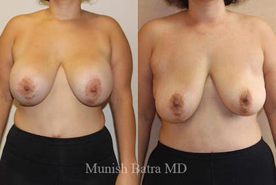 Breast Explant Before & After Gallery - Patient 216498 - Image 1