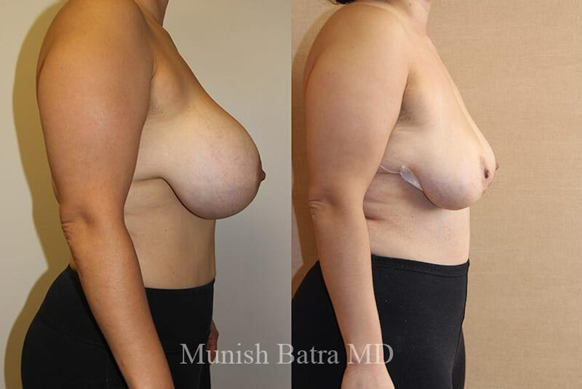 Breast Explant Before & After Gallery - Patient 216498 - Image 2