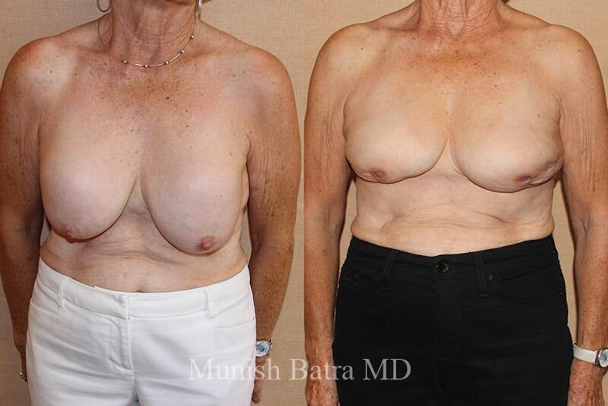 Breast Explant Before & After Gallery - Patient 424865 - Image 1