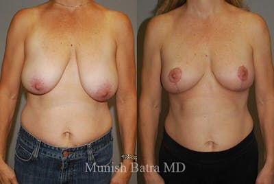 Breast Lift Before & After Gallery - Patient 106142 - Image 1