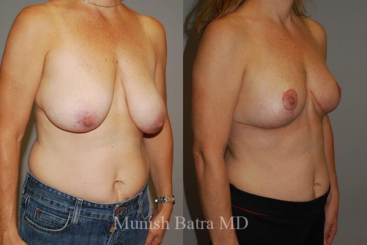 Breast Lift Before & After Gallery - Patient 106142 - Image 2