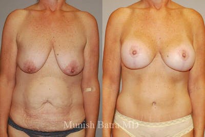 Breast Lift Before & After Gallery - Patient 174814 - Image 1