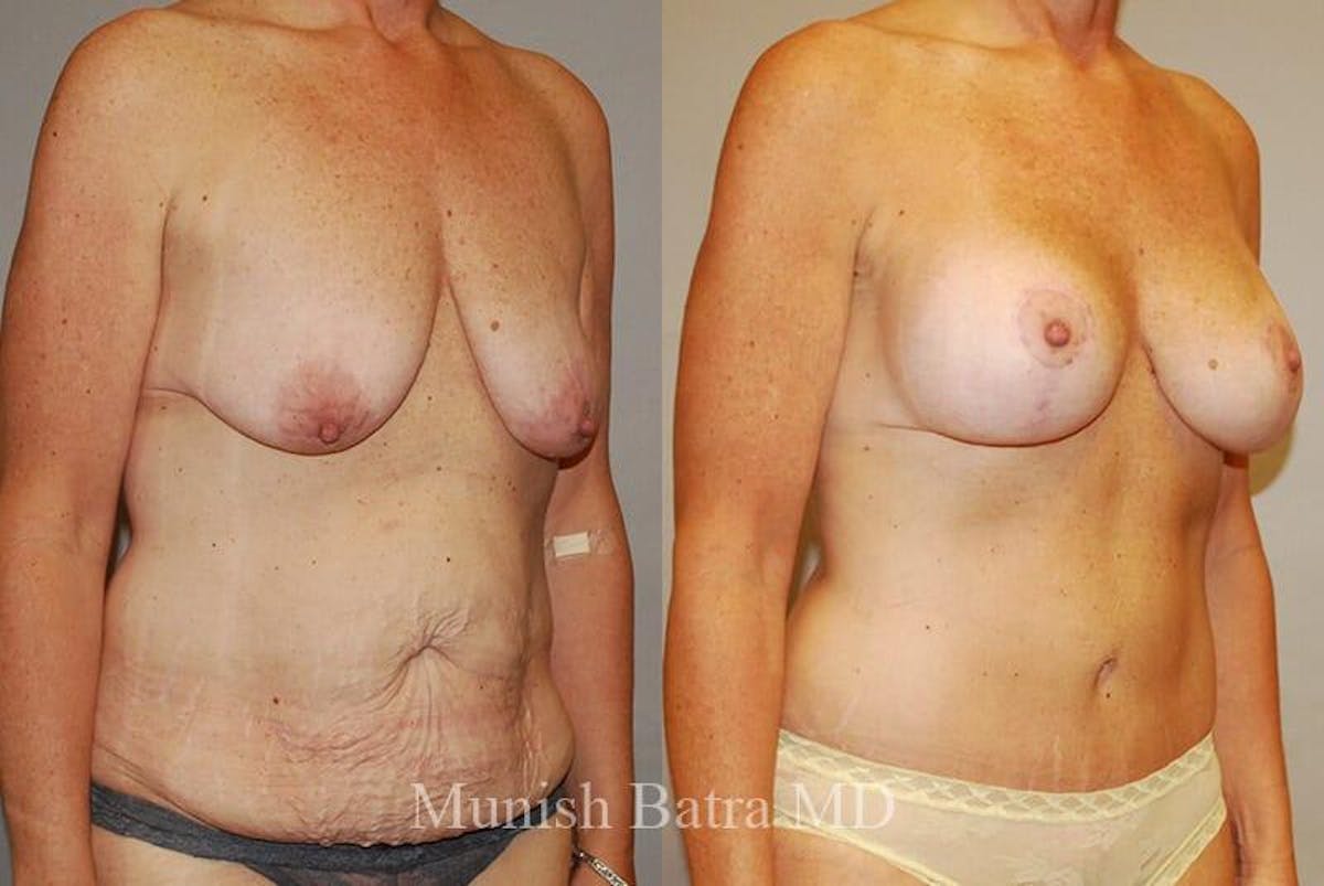Breast Lift Before & After Gallery - Patient 174814 - Image 2