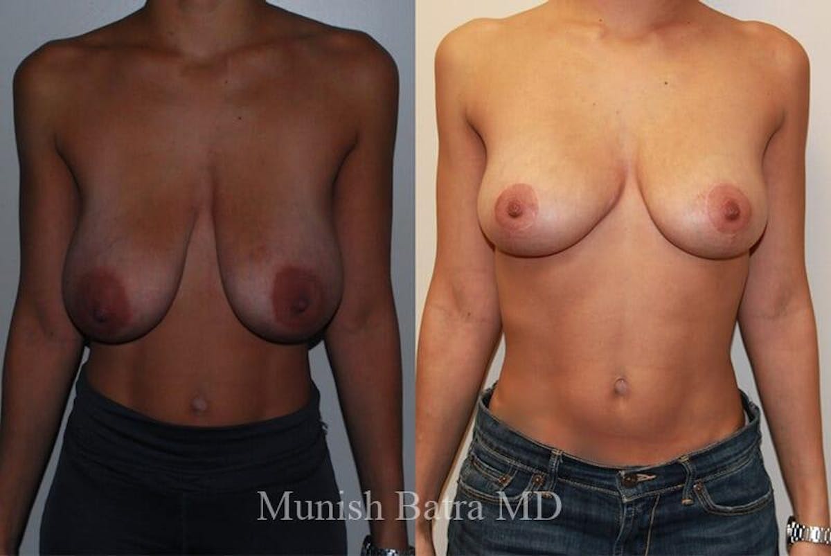 Breast Lift Before & After Gallery - Patient 402164 - Image 1