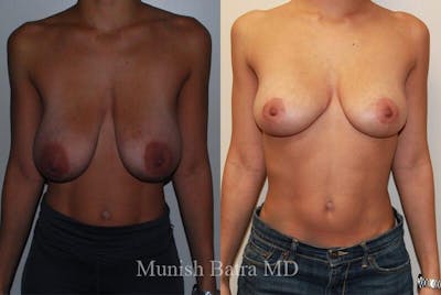 Breast Lift Before & After Gallery - Patient 402164 - Image 1