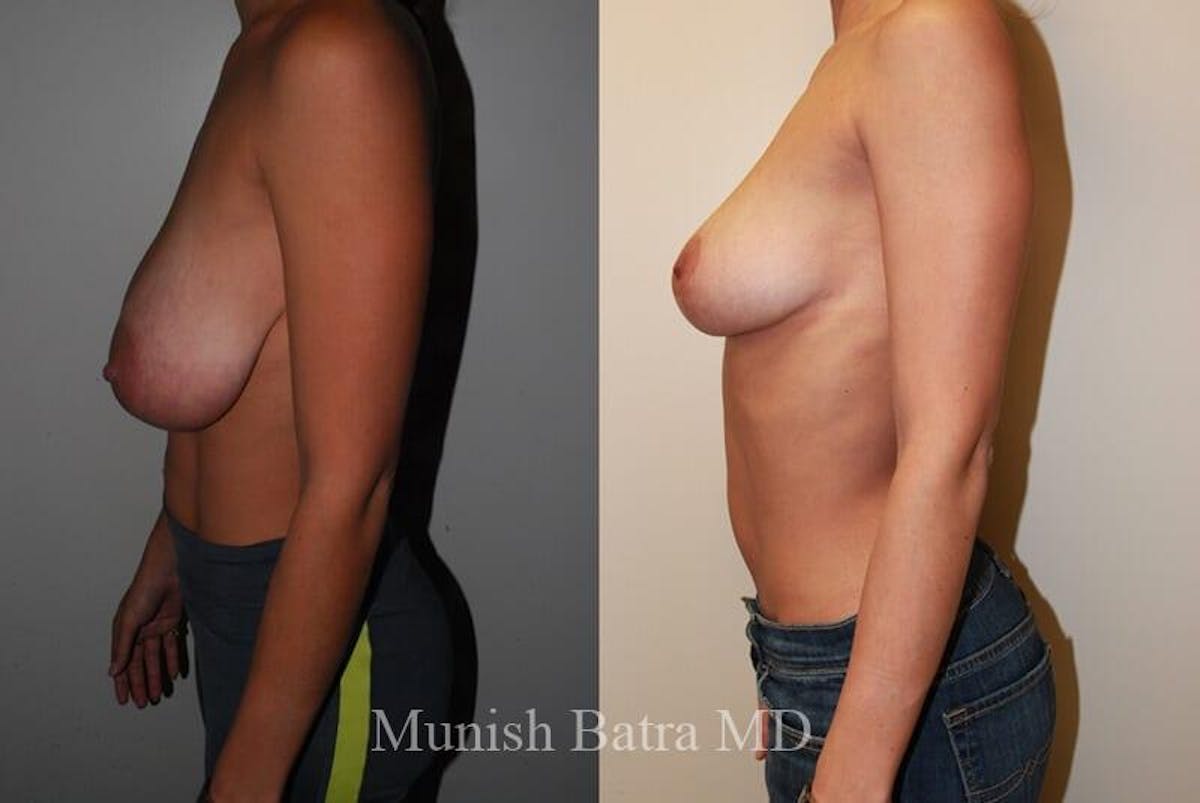 Breast Lift Before & After Gallery - Patient 402164 - Image 2