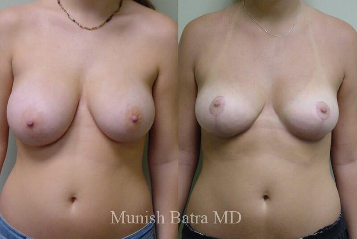 Breast Lift Before & After Gallery - Patient 739693 - Image 1
