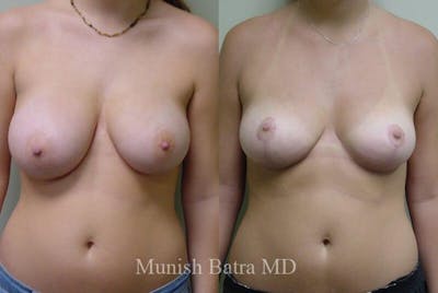 Breast Lift Before & After Gallery - Patient 739693 - Image 1