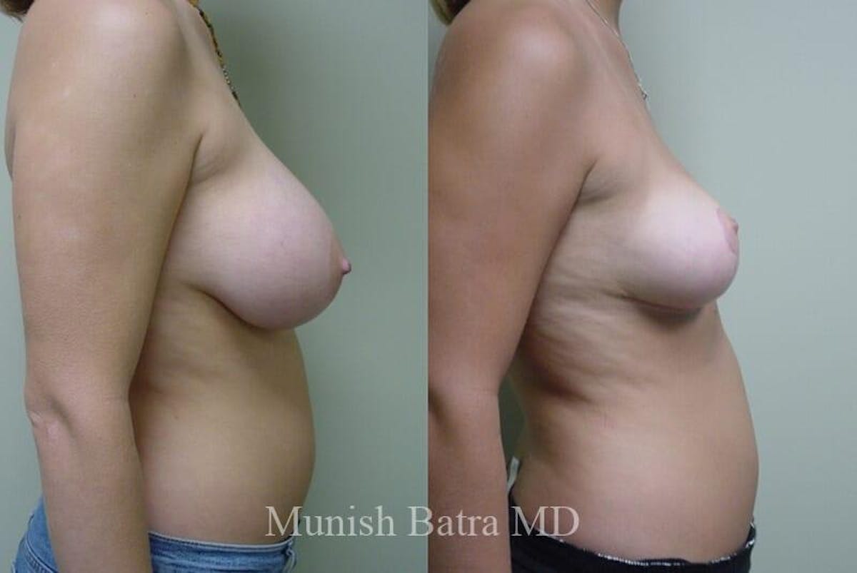 Breast Lift Before & After Gallery - Patient 739693 - Image 2