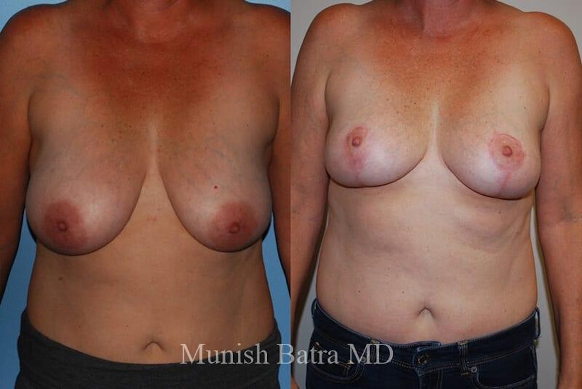 Breast Lift Before & After Gallery - Patient 258144 - Image 1